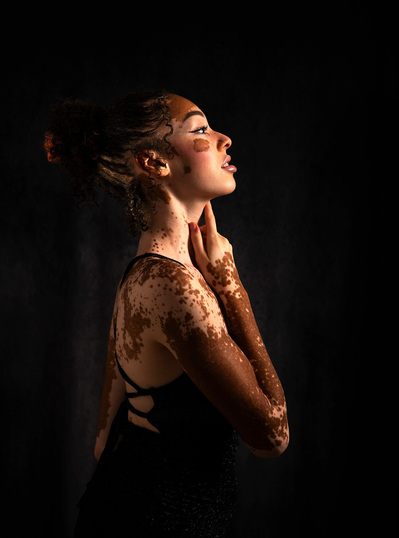 Low-key portrait of a woman with vitiligo.  
Williamsburg, VA Photographer