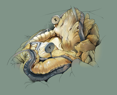 Cadaver intestines. Pen & ink, Photoshop.