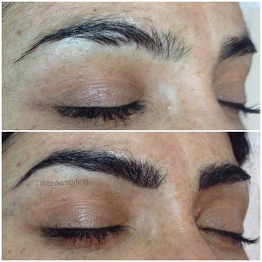 Fill in scars and spots with microblading!  BrowStyling microblading studio in Toronto