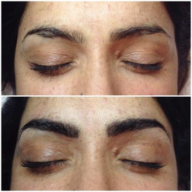 Fill in scars and spots with microblading!  BrowStyling microblading studio in Toronto