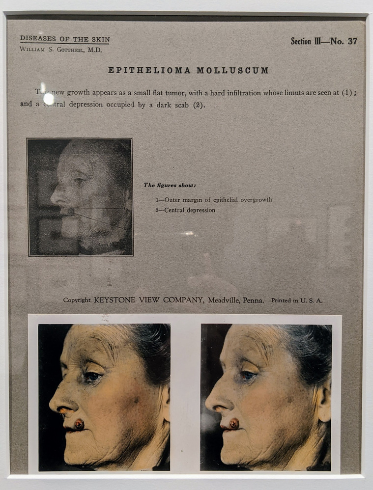 Example of a medical stereograph by Dr. William S. Gottheil showing a patient with a tumour (epithelioma). Published by the Keystone View Company. The Image Centre, Gift of Dr. Martin J. Bass and Gail Silverman Bass, 2014. Own picture