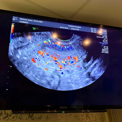Opening image to ioana marinca's documentary, Yellow Wallpaper. An image of a TV screen showing a medical scan - most of the texture is blue/grey, with bright colourful spots in yellow and red.
