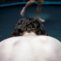 Hair growth due to medication to deal with aplastic anemia