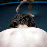 Hair growth due to medication to deal with aplastic anemia