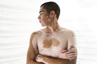 Portrait of Israeli Actor Amitai Erman with vitiligo