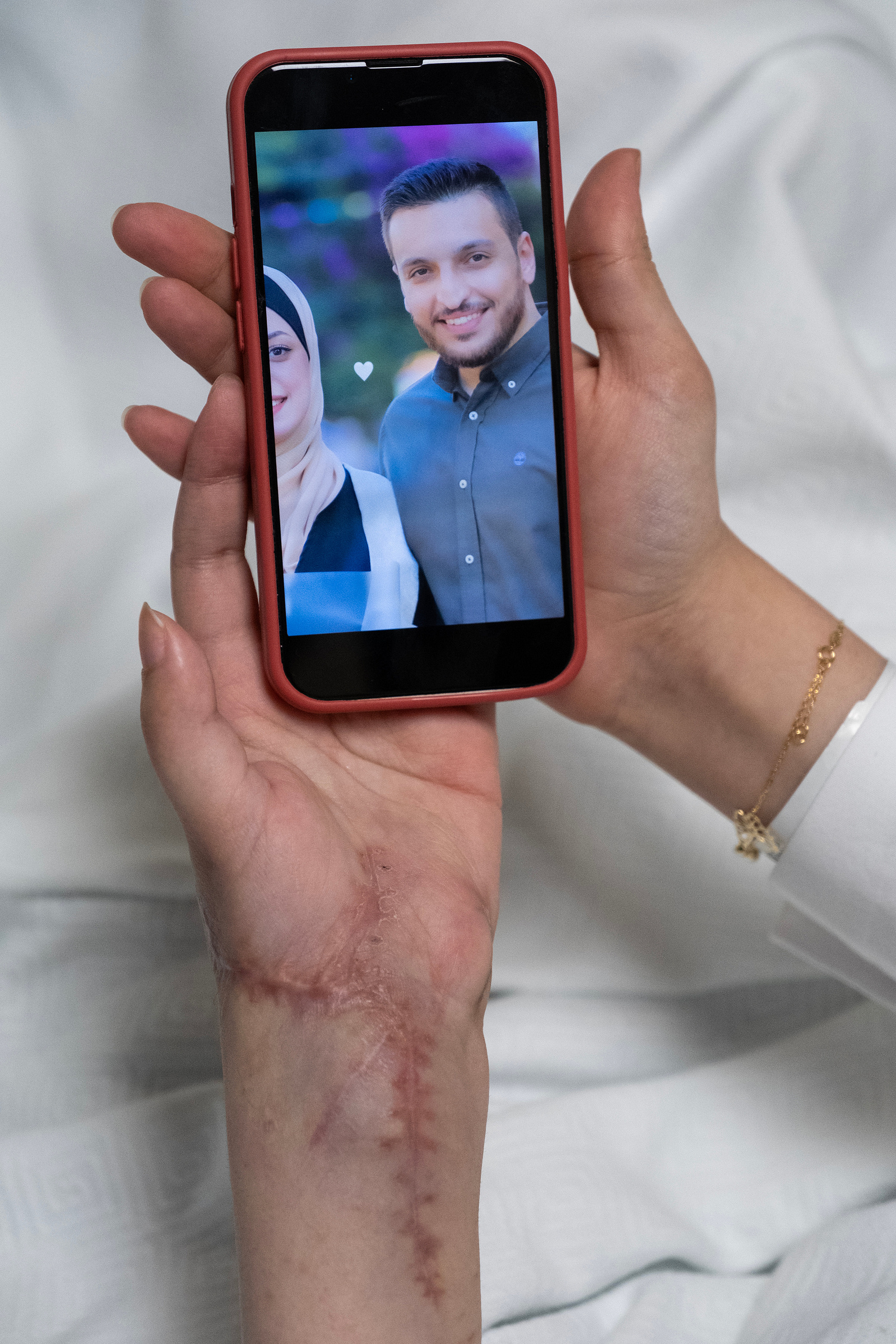 DOHA, QATAR- 30 MAY 2024
Shahed Quitati, 26, from Shamal, Gaza, holds a photograph of her dead husband as she lays in her hospital bed with one leg amputated.
Shahed was seven months pregnant, when the Israeli strike explosion was so big, it threw her