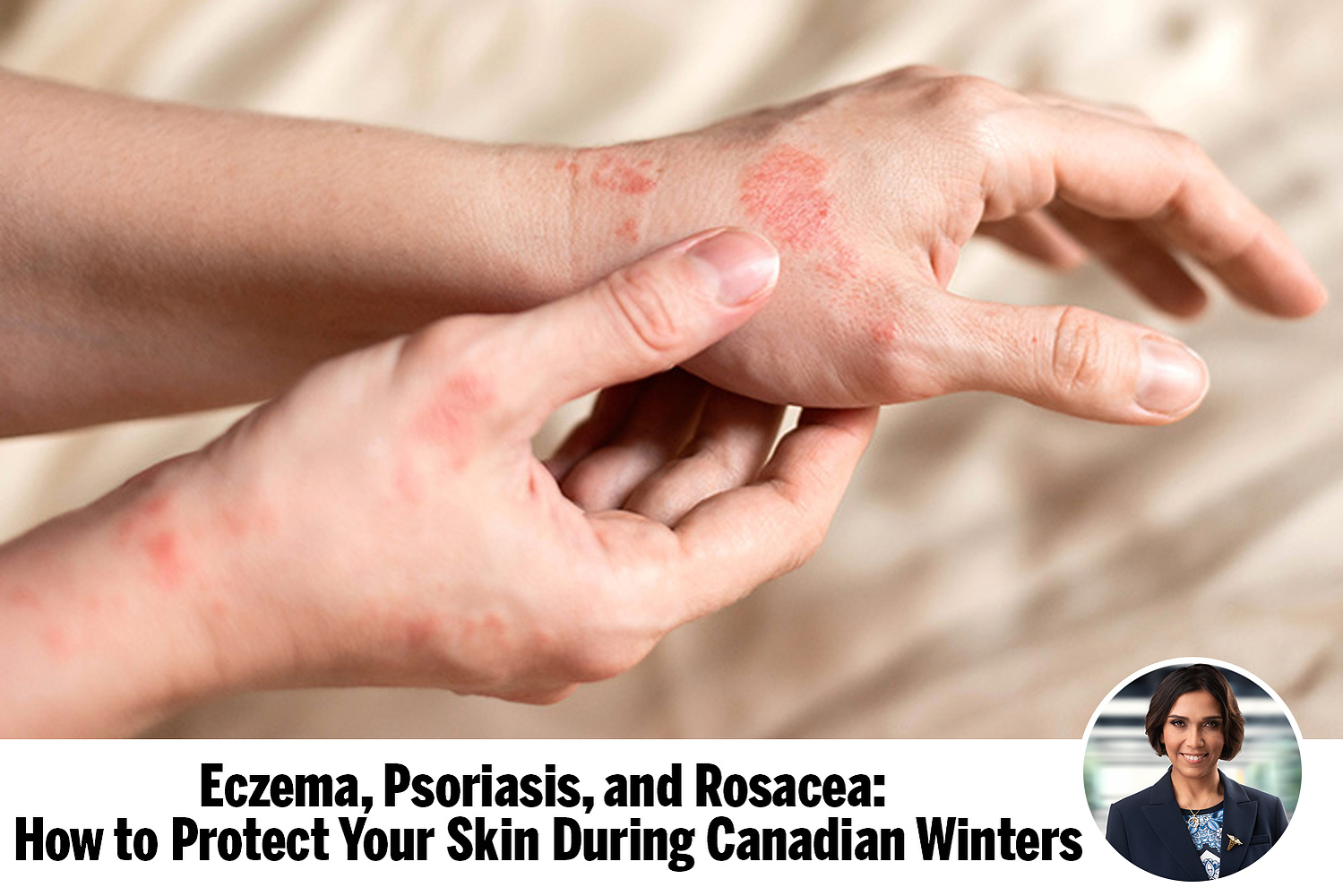 Dr. Helen Dion offers winter skincare advice for eczema, psoriasis, and rosacea patients in Panorama Hills and northwest Calgary.