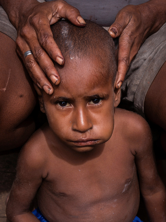 Merauke, Papua, Indonesia, 2019. Maliyaki Mahuze, 5, suffers from malnutrition. He was treated several times at the health service in their village. The number of cases of malnutrition in children has increased in deforested areas.