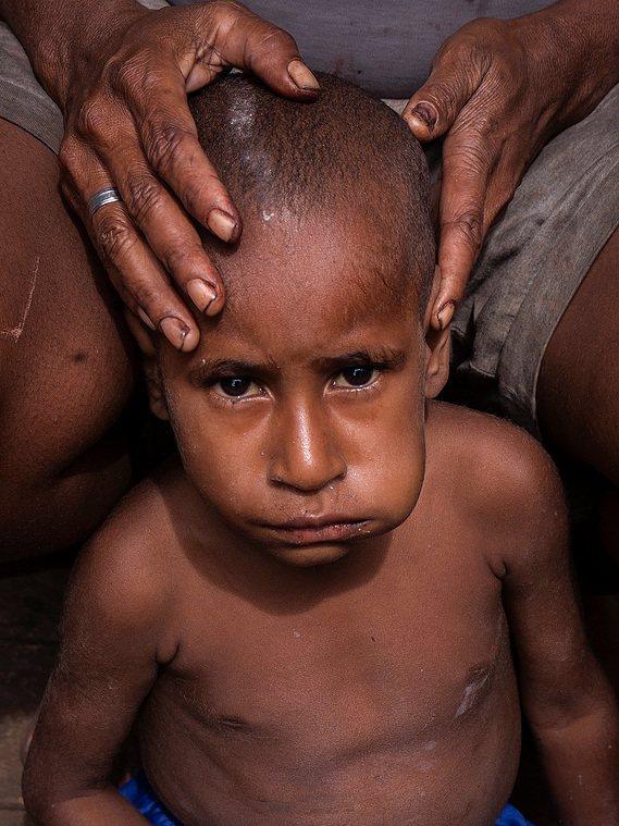 Merauke, Papua, Indonesia, 2019. Maliyaki Mahuze, 5, suffers from malnutrition. He was treated several times at the health service in their village. The number of cases of malnutrition in children has increased in deforested areas.