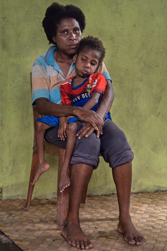 Mimika, Papua, Indonesia. 2021. Lia holds Anis, her third child with a disability and who is undergoing treatment fo tuberculosis. Lia gave birth to five children, two of which died when they were under one-year-old. There are many deaths of the children 