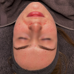 Anti aging behandeling rimpels en fijne lijntjes verminderen schoonheidsspecialiste rosmalen den bosch