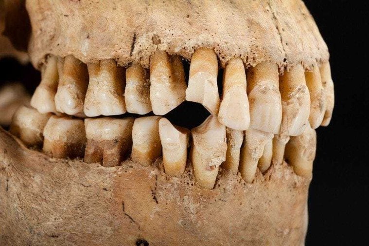close up of the teeth of a skull that have a hole worn into it where the person would've held a pipe.