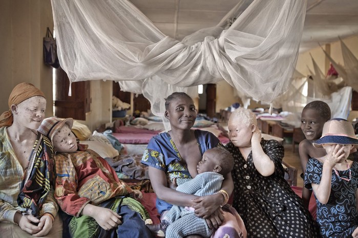 Albinos in Tanzania @ Ana Palacios Documentary Photographer