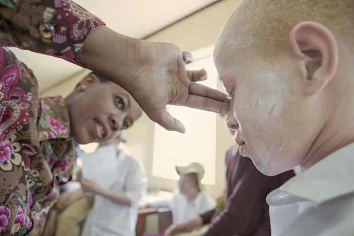 Albinos in Tanzania @ Ana Palacios Documentary Photographer