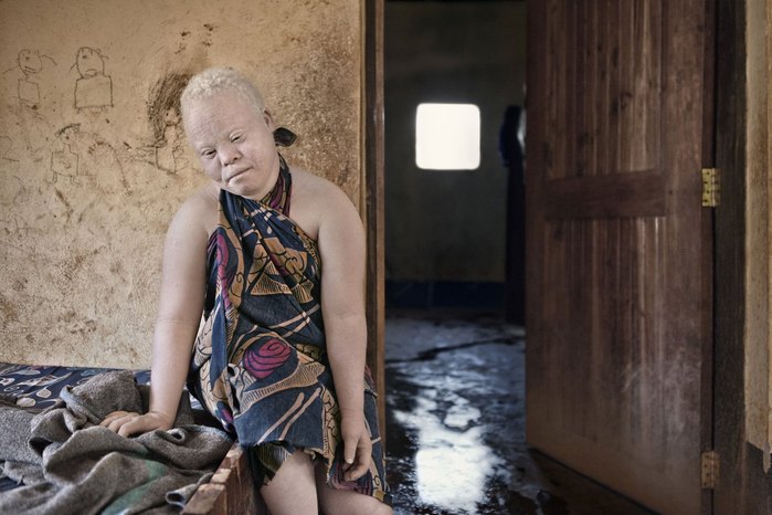 Albinos in Tanzania @ Ana Palacios Documentary Photographer