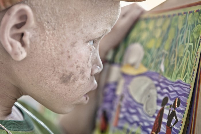 Albinos in Tanzania @ Ana Palacios Documentary Photographer