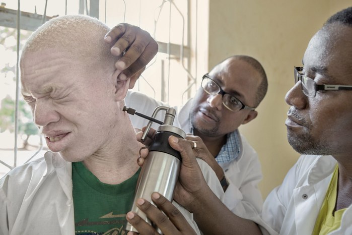Albinos in Tanzania @ Ana Palacios Documentary Photographer