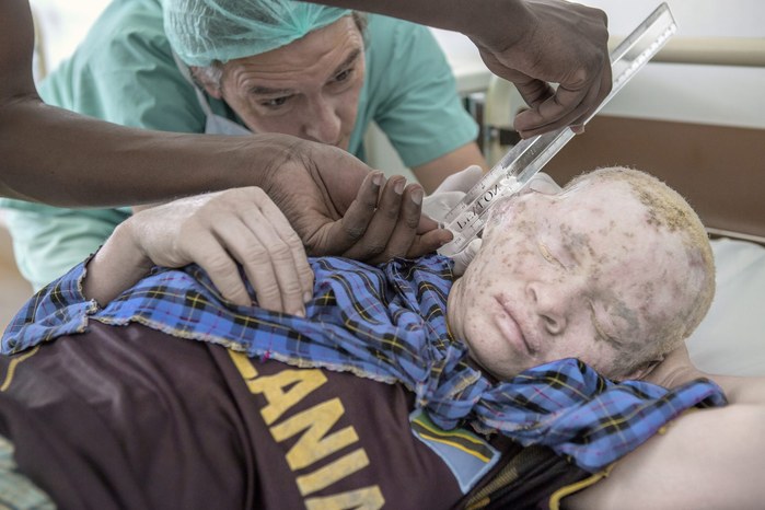 Albinos in Tanzania @ Ana Palacios Documentary Photographer