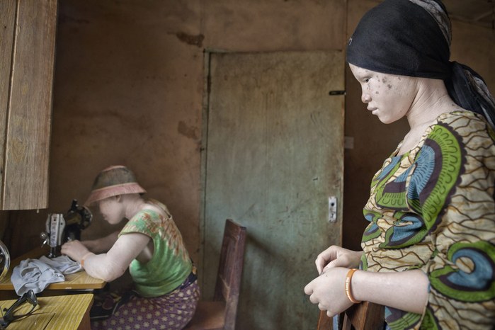 Albinos in Tanzania @ Ana Palacios Documentary Photographer