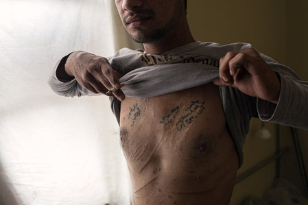 The visible signs of torture and violence on the body of a young man fleeing the Syrian civil war.